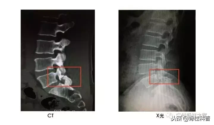 在骨科，X光、CT、MRI（核磁共振）各有优势，不是越贵越好！