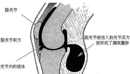 膝盖酸胀不适，后方有肿块？当心腘窝囊肿，中老年人高发