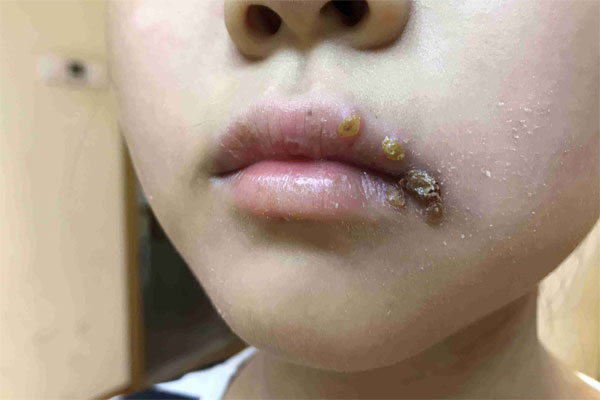 嘴上长水泡,可能是感染疱疹病毒!如何才能快速消除?能挑破吗?
