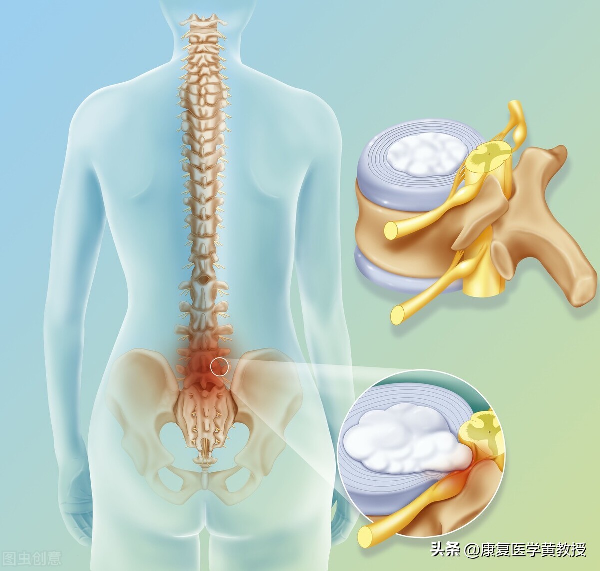 骨刺是一种病吗？按摩贴膏药可以消除骨刺吗？