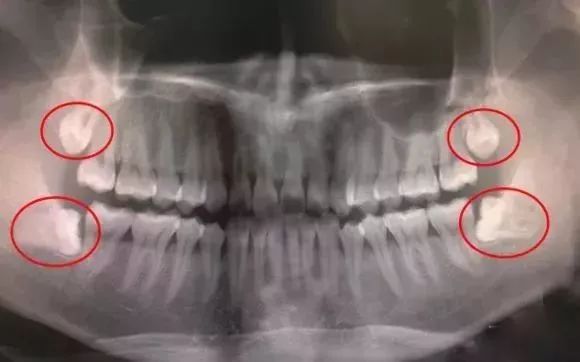 啥是阻生智齿？为什么去医院拔个智齿收费天差地别