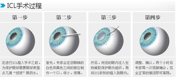 医生都不做近视手术？当然不是，来看看曾医生做手术的亲身经历