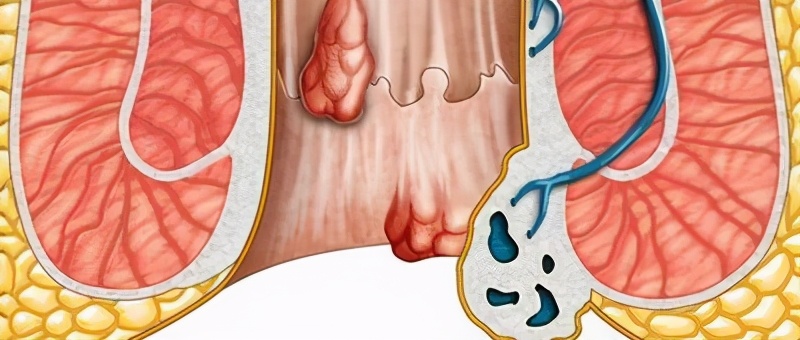 3.结肠镜检查,肛管镜检查仔细检查齿状线上下,注意肛窦有无充血