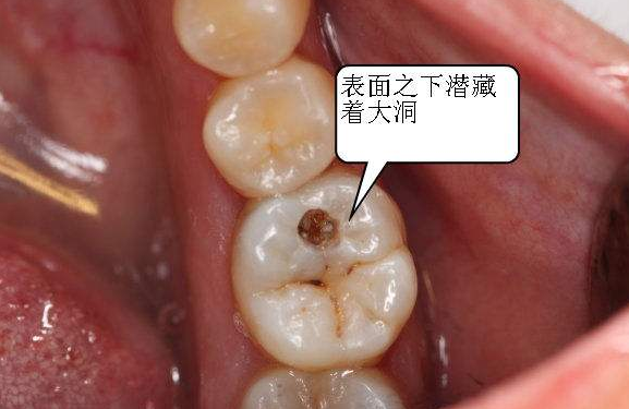一旦发现根尖周炎的相关症状,应及时就医接受检查,根据牙齿目前的情况