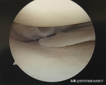走走路突然膝盖就软了，要摔倒，还疼，是啥情况？医生详细告诉您