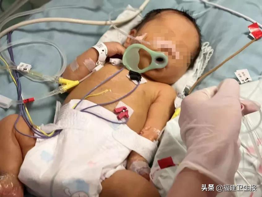 惊险!福州一宝宝刚出生便全身换血!这种病和血型有关,孕期注意排查