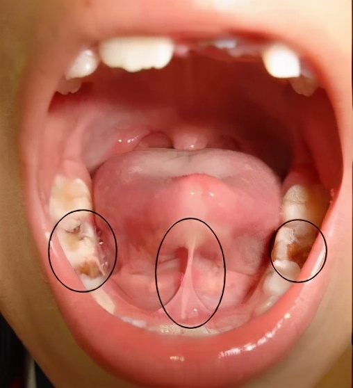 宝宝喝水“嘴漏”、咬字不清？快看是 不是舌头被「锁住」了