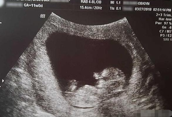 女子怀孕14周流产,"胎儿"模样曝光:仅指甲盖大小但手脚已成型