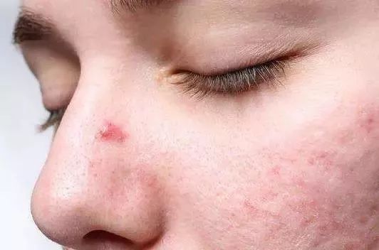脸上泛红发痒、出油长痘？“螨虫脸”真的很丑，除螨刻不容缓