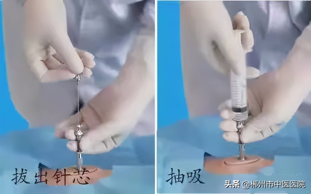 骨穿其实是一个很小的操作,一般情况下会选取富含骨髓丰富的髂后上脊