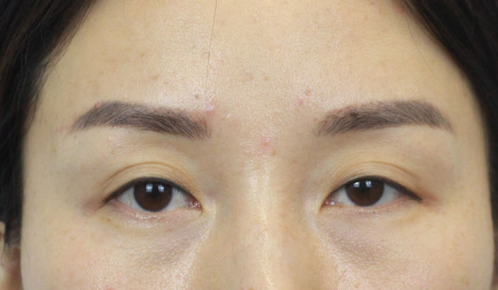 使用双眼皮贴可以贴出来双眼皮是真的吗？