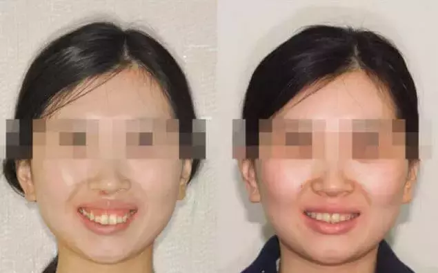 龅牙嘴突+露龈笑:牙齿矫正告诉你这些都还有救