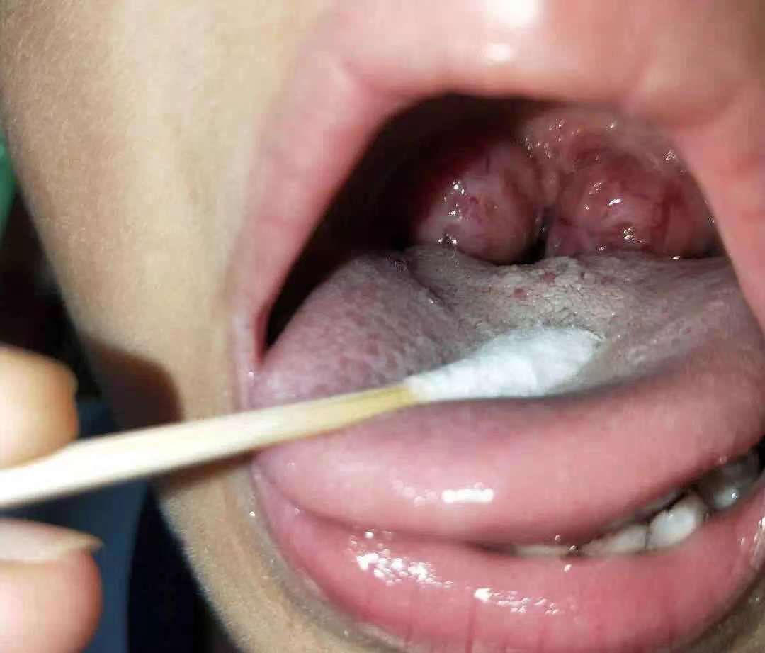 孩子扁桃体反复发炎，家长应该怎么做，三分钟带你了解