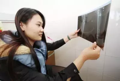 “钢”板要不要取?这是一个问题