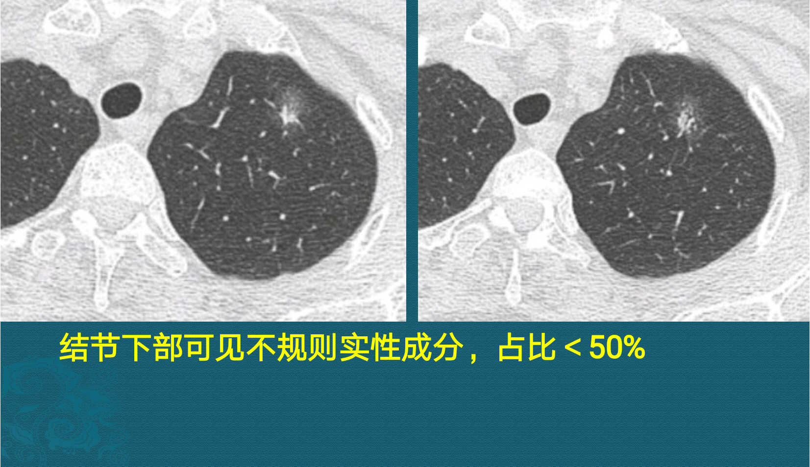 闢謠:ct報告中的