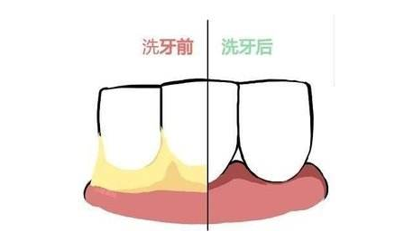 牙医揭秘：花几十到几百块洗一次牙有没有意义？洗牙难道很暴利？