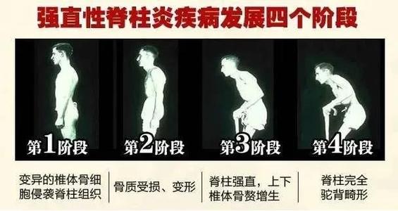 腰痛之捉妖记（十五）------能动还是能冻，神秘的骶髂（下）