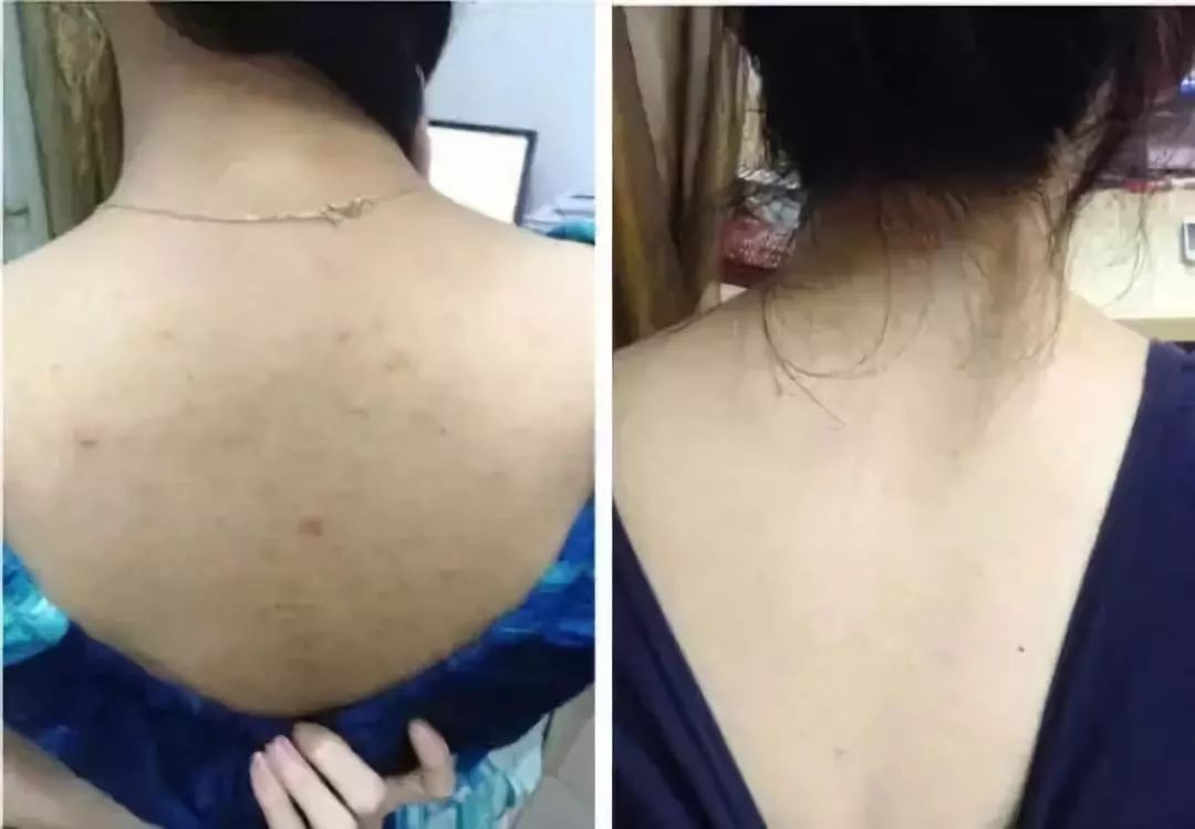 寒冬来了，身上又起皮干燥？戚薇教你一妙招，只需抹一下就好