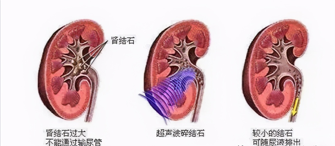 体检查出肾结石，别慌：3个方法，或能让肾结石离开身体