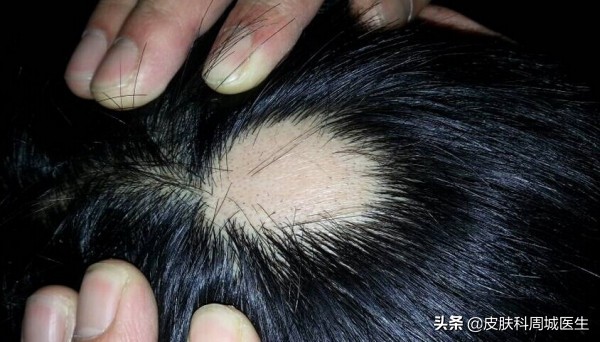 一块一块脱发太可怕，斑秃该如何治疗？