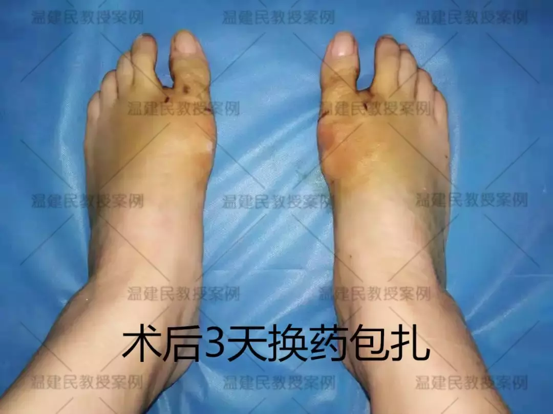 案例:轻度拇外翻不治疗,拖延20年成重度,疼痛难忍才来手术