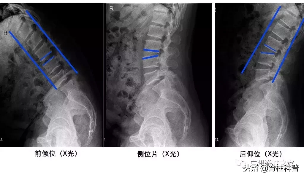 在骨科，X光、CT、MRI（核磁共振）各有优势，不是越贵越好！