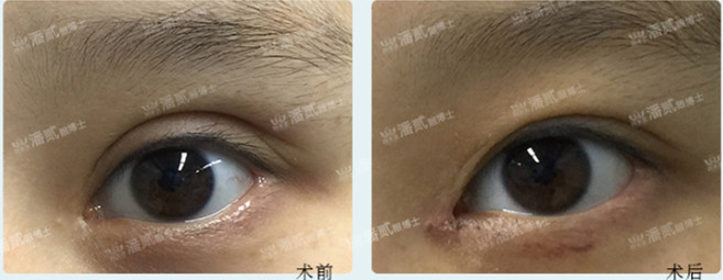 双眼皮修复之上睑”鼓鼓“的，为啥还要填脂肪？
