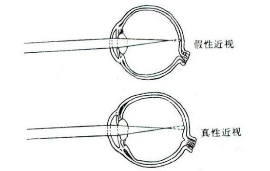 什么是儿童假性近视 如何区别假性近视、真近视？