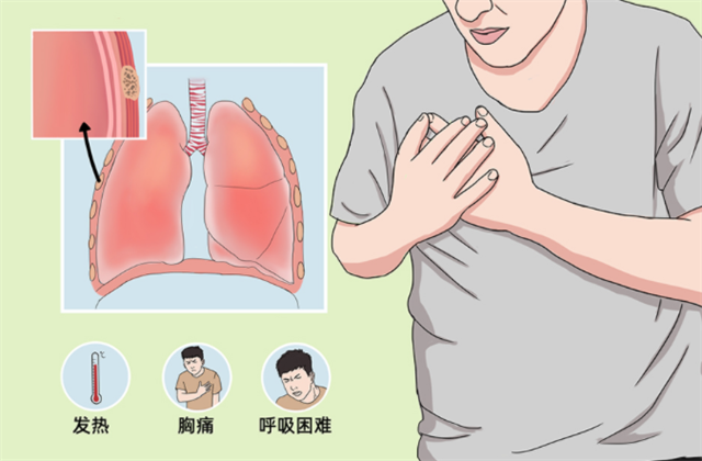 胸腔积液是什么原因造成的(胸腔积液是什么引起的?是良性还是恶性?