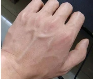 辟谣:手上青筋凸起,是毒素淤积吗?医生说出真相,很多人不知道