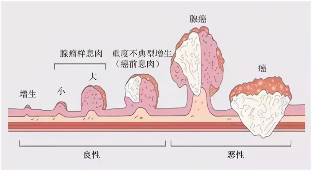 肛门长个小肉球，难道是肠癌前兆？杨大夫告诉你怎么处理