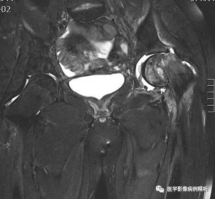 垂体柄阻断综合征并股骨头骨骺滑脱MR典型影像表现及分析思路