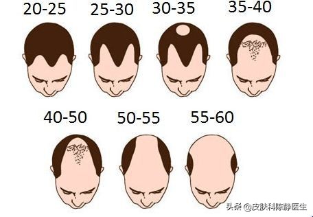 雄激素性脱发的科学治疗方法与应对策略