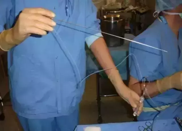 大二女生卖卵,三天后肚子大如孕妇险丧命!卖卵的危害有多大?