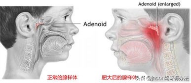 4个月大婴儿腺样体肥大（孩子鼻塞总爱张口呼吸腺样体肥大怎么办）