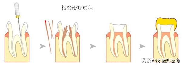 蛀牙烂到神经，就要做根管治疗？