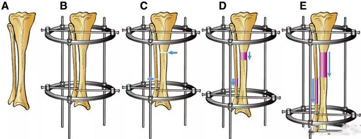 断骨增高术多少钱什么是断骨增高手术