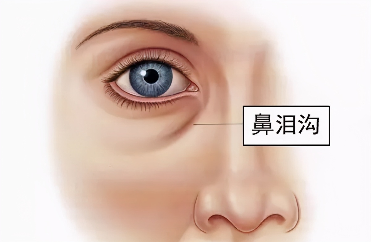 泪沟和眼袋的区别是什么 你真的以为自己眼底的是眼袋？