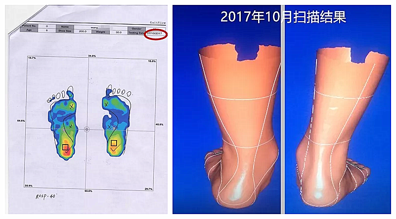 为什么我的孩子有副舟骨疼痛？孩子走路总觉得疲劳是怎么回事？