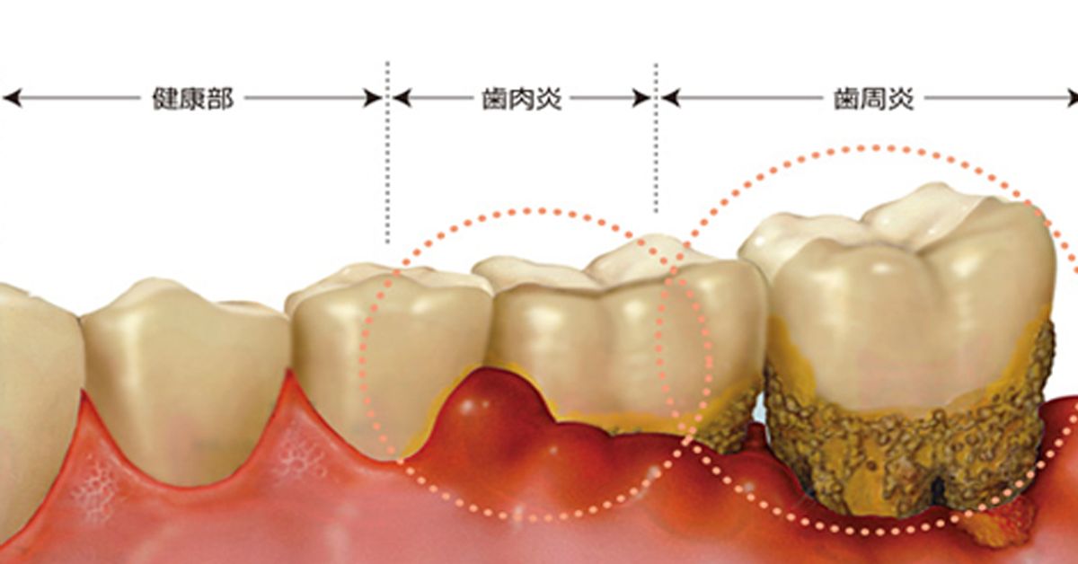 牙龈萎缩非小事,拖久不治危害大,初期不治晚期花费上万都难恢复