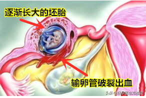 宫外孕征兆 征兆有哪些？