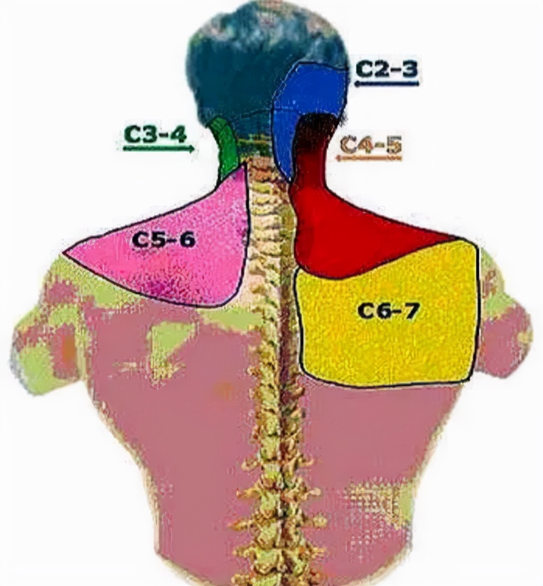 右后背不同部位疼痛图图片