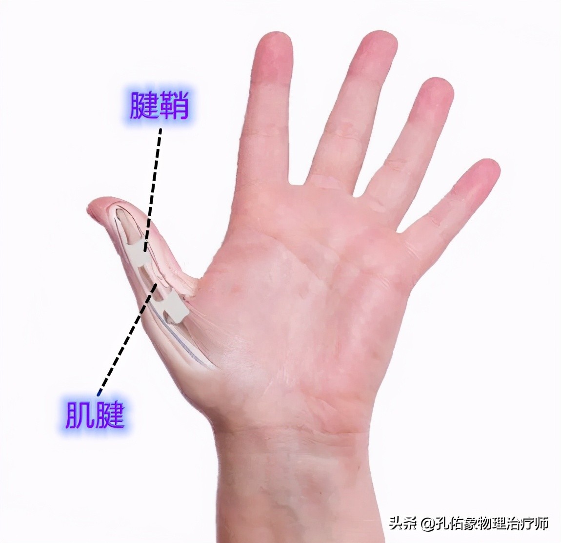 更年期女性极易遭受腱鞘炎的折磨,为什么?该如何治疗?