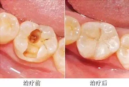 几十块钱就能补好的牙,久拖不治,以至要花上万,冤不冤?