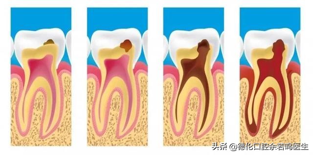 同样是补牙，为什么你去补牙，价格却这么贵？