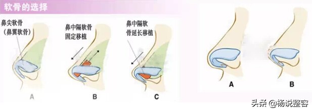 科普：隆鼻失败后怎么修复呢？