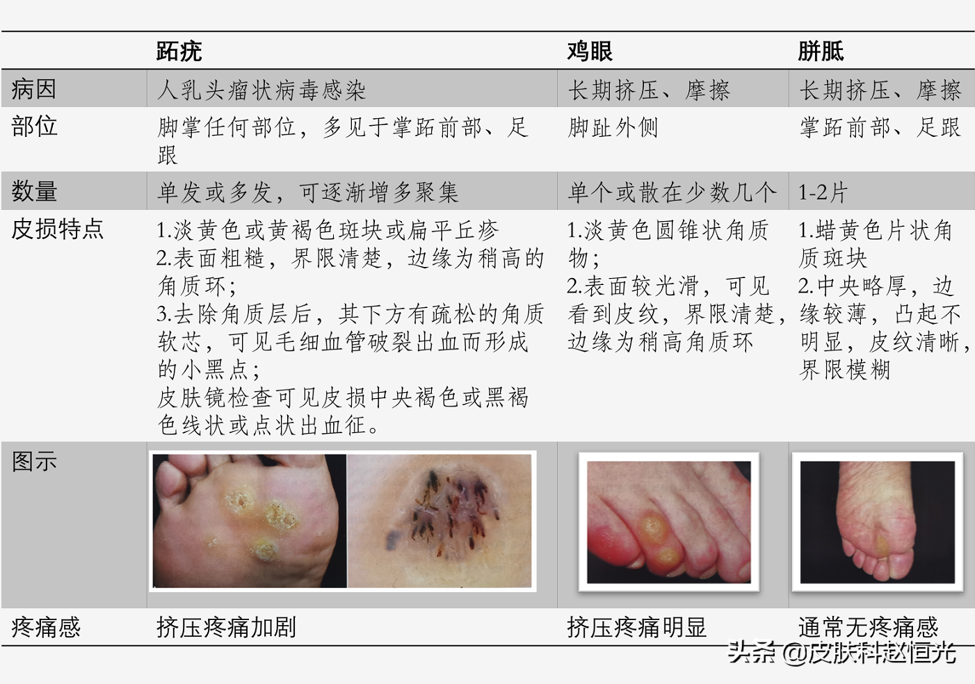 脚上长的这个东西，医生说不是鸡眼，是另一种病！