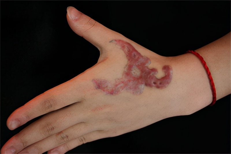 这四招让皮肤在手术后完美恢复告别疤痕