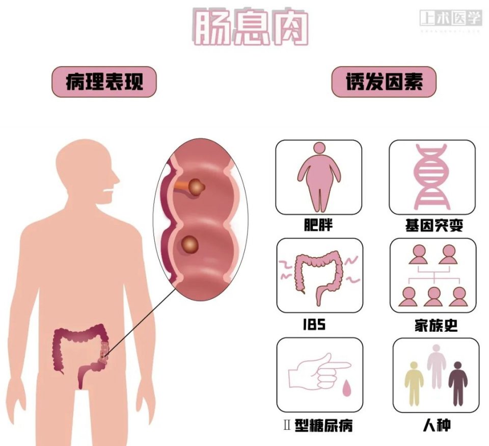 肠息肉 是怎样在内镜下切除的？