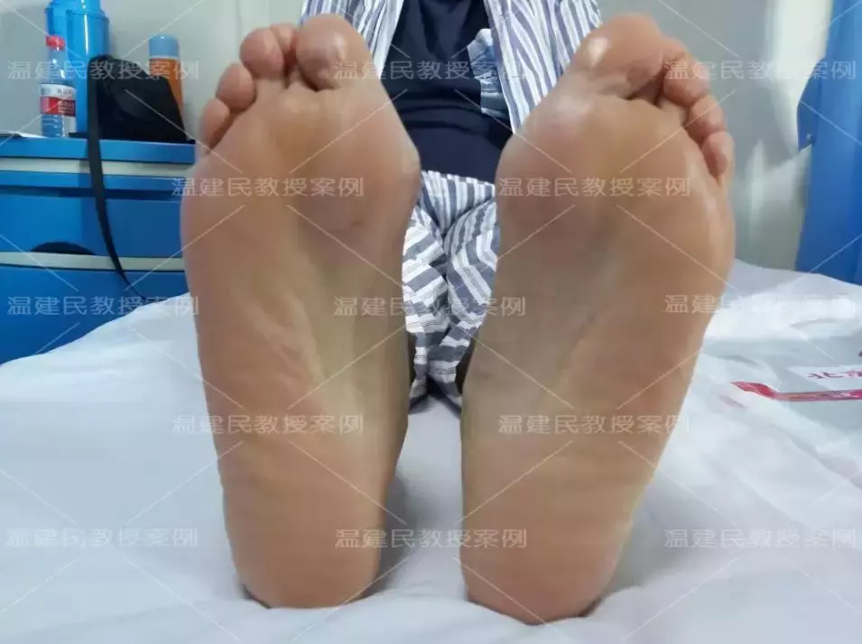 案例:轻度拇外翻不治疗,拖延20年成重度,疼痛难忍才来手术